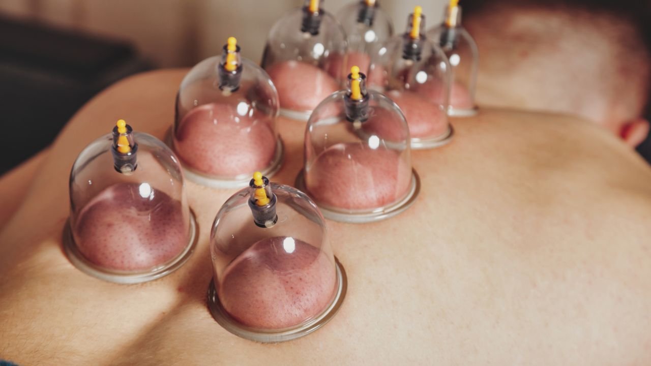 can cupping marks be permanent
