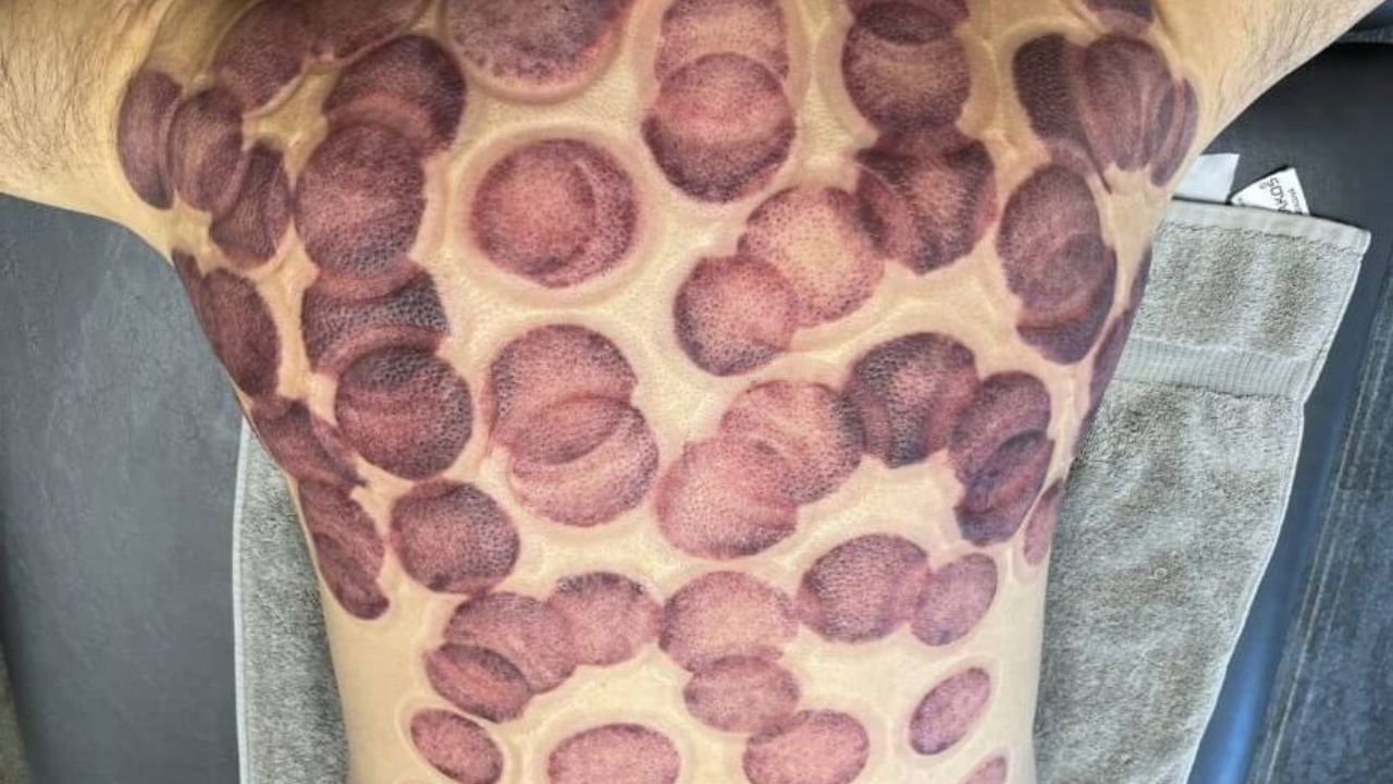 benefits of cupping