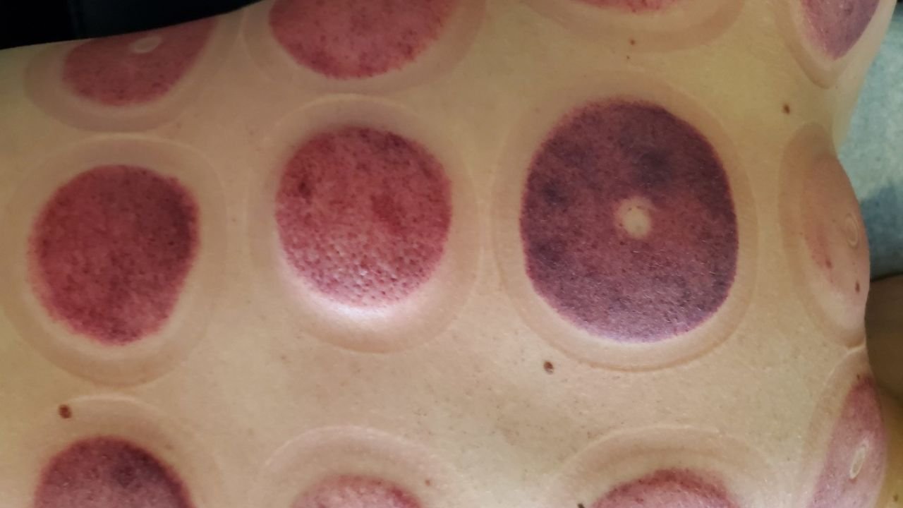 temporary skin discoloration